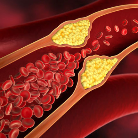 Homocystein – ein Risikofaktor für Arteriosklerose