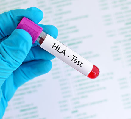 HLA B27 als molekulargenetischer Test