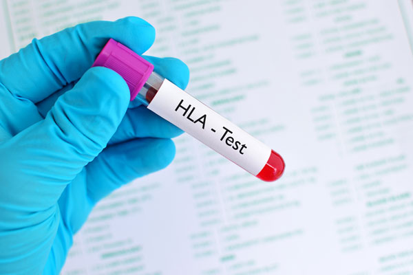 HLA B27 als molekulargenetischer Test